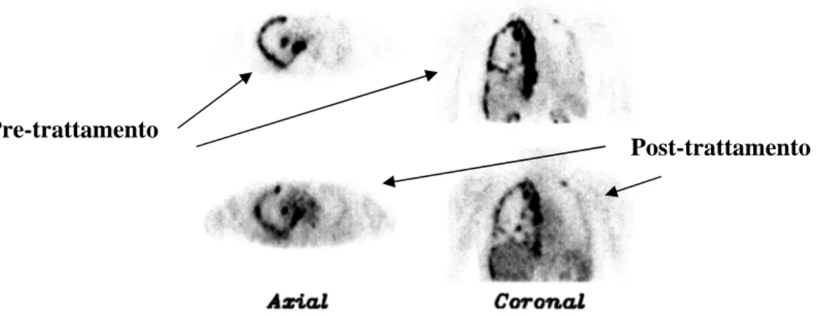 Fig 5: Immagini PET ottenute prima e dopo terapia di un mesotelioma 