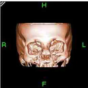 Figura 3.13: La ricostruzione tridimensionale della superficie del cranio di un paziente utilizzando l’algoritmo marching cube sulle slice del cranio.