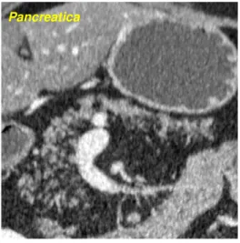 Fig.  3-Pattern  B1- Dopo  somministrazione  del  mezzo  di  contrasto  la  lesione  neuroendocrina pancreatica  appare evidente fin dalla fase arteriosa precoce, con persistere  del wash-in anche nelle fasi  venosa e tardiva
