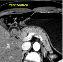 Fig. 4 - Pattern B2- La sospetta lesione neuroendocrina pancreatica resta isodensa rispetto  al  circostante  parenchima  ghiandolare  sia  nella  fase  arteriosa  precoce  sia  nella  fase  pancreatica,  con  lento  wash-in  che  inizia  solo  nella  fase