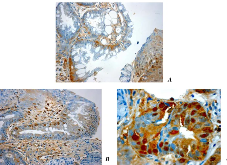 Figura 4.10. Immunoistochimica di biopsie di esofago di Barret. Anticorpo anti- anti-GSTO1; controcolorazione con ematossilina