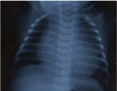 Figura 1.2 Rad iografia  d el torace d i u n  neonato con  stenosi valvolare aortica  critica