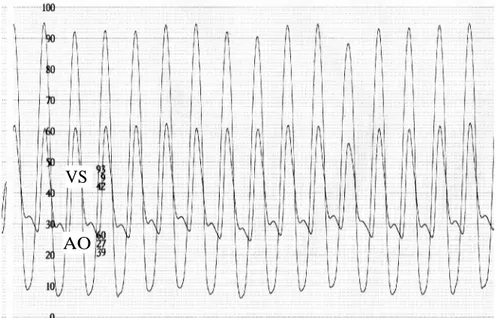 Figura 3.3 Gradiente pre-dilatazione.  