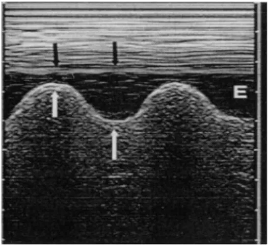 Figura 19. [1] Immagine M­Mode di un  veramento   pleurico.   Mostra   la   variazione  dinamica   durante   la   respirazione   della  distanza tra pleura viscerale e parietale. Il 