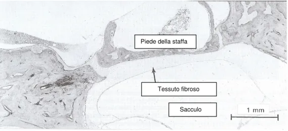Figura 3: tessuto fibroso nelle vicinanze del piede della staffa  