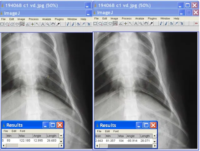 Fig II-3 e II-4 Screenshot del software ImageJ durante la misurazione dell’arteria lobare caudale e del 