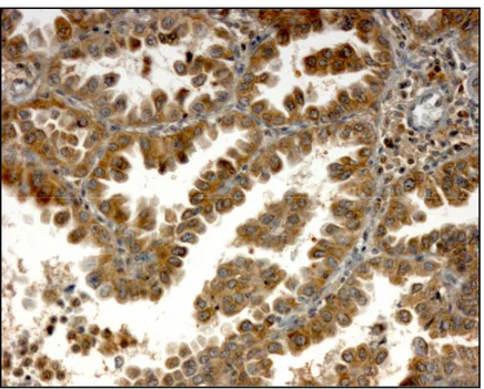 Fig.  21  Esempio  di  campione  NSCLC  positivo  per  ET-1  all’analisi  immunoistochimica  