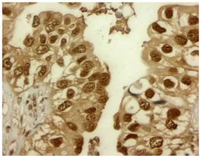 Fig.  24    Espressione  immunoistochimica  del  recettore  estrogenico  β  (ER-  β)  in  campioni di adenocarcinoma polmonare
