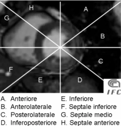 Fig. 2.2.3 Segmentazione 3D del ventricolo sinistro secondo le 17 regioni di  vascolarizzazione coronarica