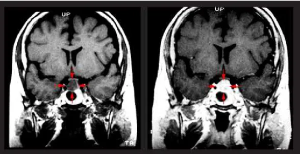 Fig. 7 - Donna di 37 anni con malattia di Cushing causata da un macroadenoma di 9  x 11 x 14 mm