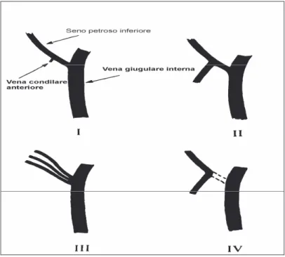 Figura  13  –  Schema  delle  quattro  variazioni  della  giunzione  tra  seno  petroso  inferiore  e  vena  giugulare  interna, descritto da Shiu et al