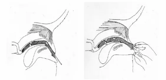 Figura  3:  Rappresentazione  grafica  dell’anatomia  della  vagina  e  del  vestibolo  della  cagna  e  dell’angolo  appropriato  per  introdurre  il  tampone  nel  vestibolo  e  nella  porzione caudale della vagina.