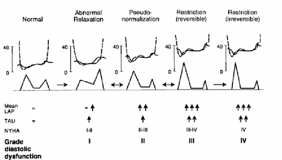 Figura 1:  il sistema di gradazione proposto per la disfunzione diastolica  basato sulla  progressione  del  pattern  della  velocità  di  flusso  transmitralico