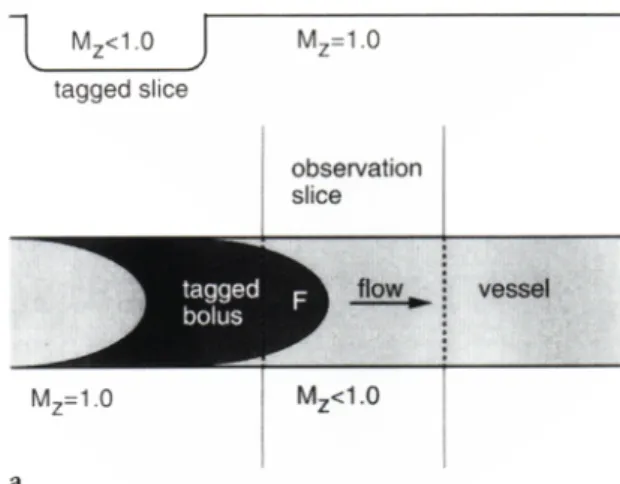 Fig. 4-1. TOF effect in a vessel crossing the slice of acquisition.  
