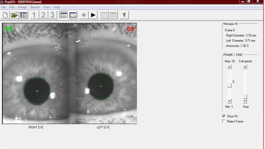 Fig. 10. Misurazione digitale del diametro pupillare, in condizione 