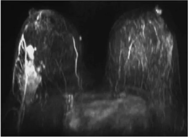 Fig.  4  MIP  in  assiale.  Apprezzabile  enhacement  multinodulare al QSE dx 