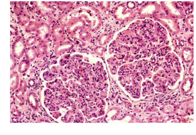 Fig 3.2.3a Glomerulonefrite crioglobulinemica: lesioni membranoproliferative con notevole ipercellularità,  aumento di volume e lobulazione glomerulare (in M.O.)