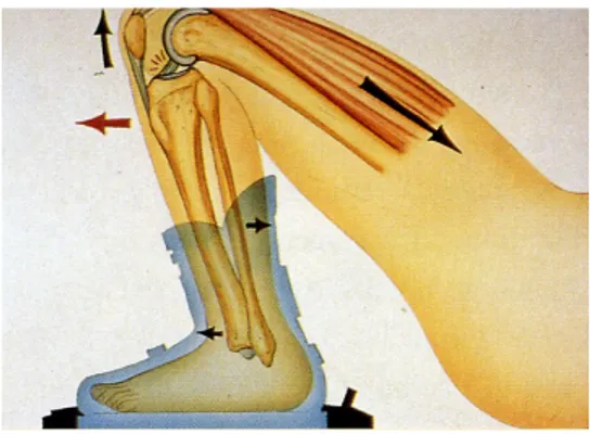 Fig. 17: lesione del LCA durante la pratica dello sci alpino