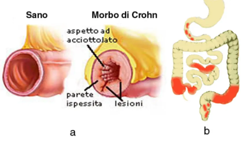 Figura 2.13: a. Confronto tra parete intestinale sana e parete affetta da morbo di Crohn b