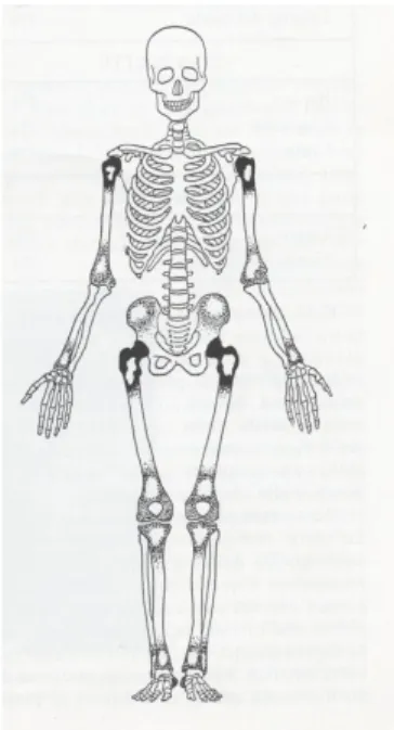 Fig.   5/1:   Cisti   ossea   giovanile:   sede   delle   lesioni   (nero=frequente; punteggiato=poco; bianco=raro)