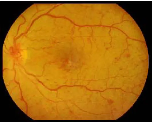 Fig 3. Quadro di Retinopatia Diabetica non Proliferante.