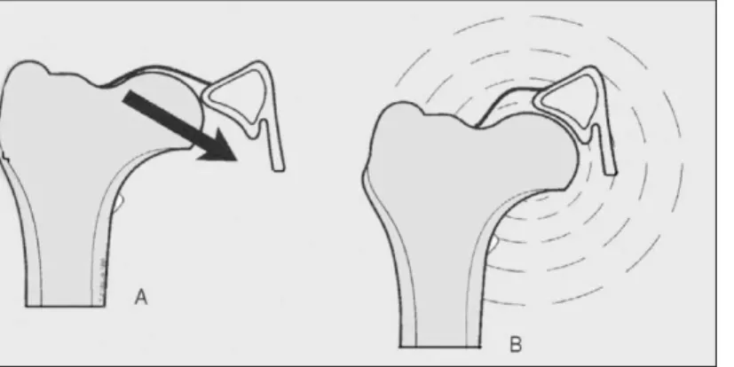 Figura  6  –  Rumore  di  “clunk”  prodotto  dall’anca durante la deambulazione, causato  dalla  riduzione  del  femore  all’interno  dell’acetabolo