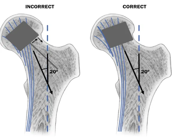 Figura 6-Diagramma che rappresenta il non corretto ed il corretto posizionamento  della componente femorale nell’artroplastica di anca