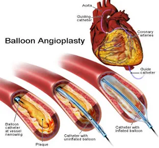 Figure  2.5:  Balloon  angioplasty