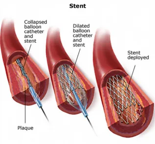 Figure 2.8: Stent implantation