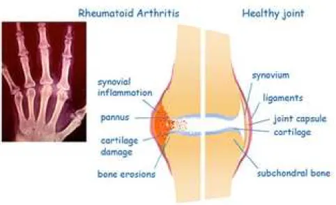 Fig. 4 – Articolazione interessata dall’AR messa a confronto con un’articolazione  sana