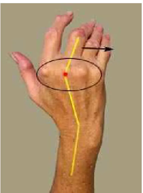 Fig. 7 – Deviazione ulnare delle dita della mano. 