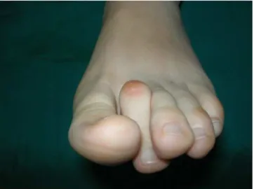 Figura 8 – Deformità a martello del secondo dito del piede 