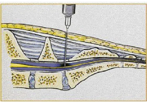 Figura 2.1.: Punzione epidurale lombo-sacrale.