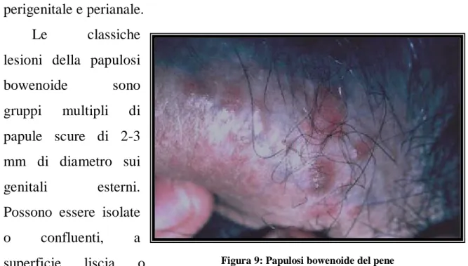 Figura 9: Papulosi bowenoide del pene