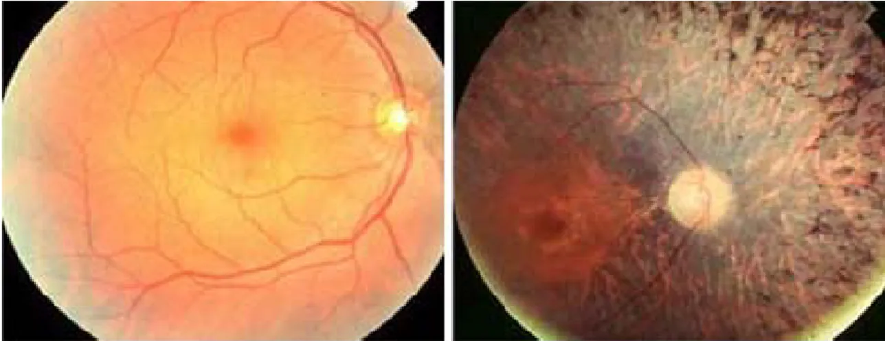 Fig. 13 . Fundus views of the retina of a normal human subject (left) and of a RP patient (right)