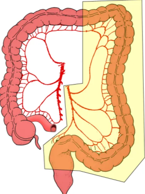 Fig. 4: Emicolectomia Sinistra