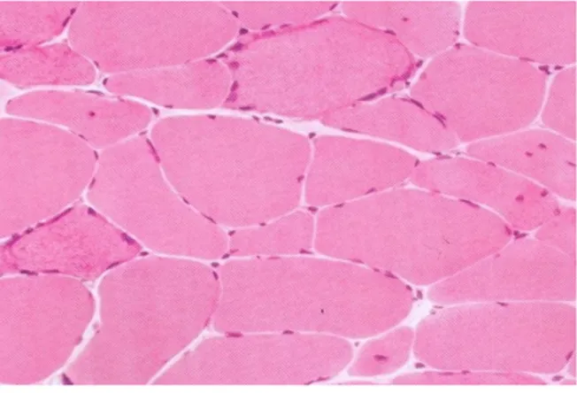 Figura 4. Ragged red fibers (RRF). Sono osservabili due RRF in alto a destra ed 