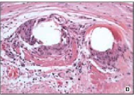 Figura 1.8: Intenso infiltrato di cellule infiammatorie intorno  alle maglie metalliche dello stent