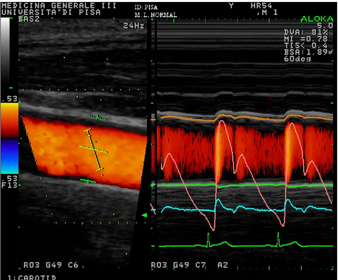 Figura 4.2: Esempio di studio della meccanica arteriosa con metodica “E-track” a livello dell’arteria carotide  comune