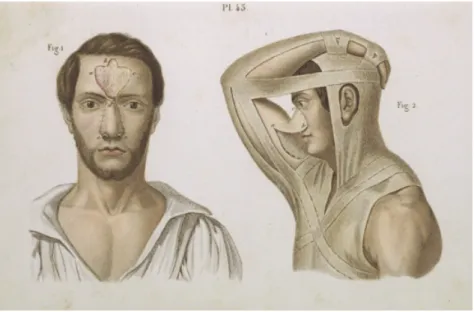 Figura  2:  Ricostruzione  del  naso  con  la  cute  della  fronte  e  della  parte  superiore del braccio