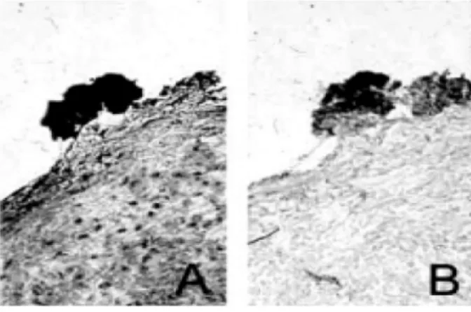 Fig. 1.10 GGT cataliticamente attività in microtrombi presenti sulla superficie di una  placca aterosclerotica umana
