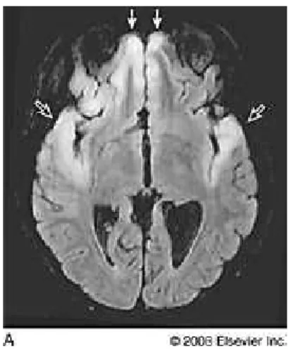 Figura 1.6: risonanza magnetica di un paziente con encefalite erpetica; le freccie indicano le aree di interessamento