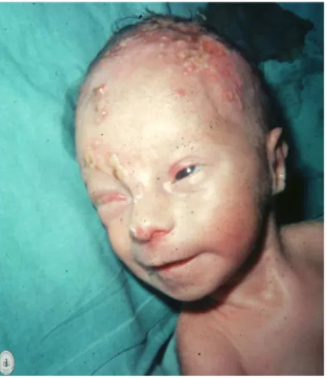 Figura 1.5: Neonato con herpes neonatale 