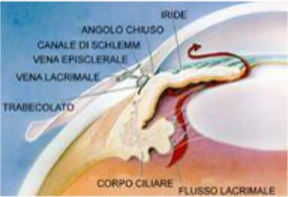 Fig. 7: Glaucoma ad angolo chiuso 