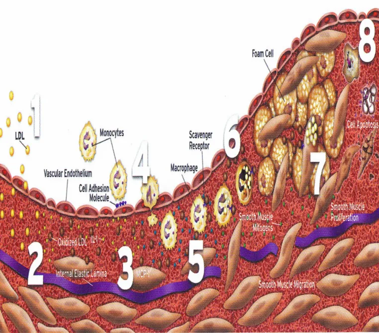 Figura 3. 1: Accumulo di lipoproteine nell’intima 2: Stress ossidativo: ossidazione delle lipoproteine 3:  Aumento dell’espressione delle molecole di adesione 4: Chemiotassi leucocitaria 5: Formazione delle  foam cells 6 : Aumento delle cellule muscolari l