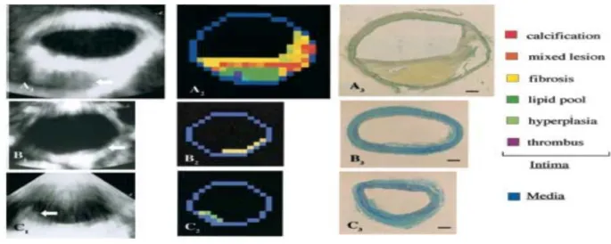 Figura 6 Immagine , in sezione trasversa, di IBS carotide comune, da Kawasaki M et al,  JACC 2001; 38: 486-92 