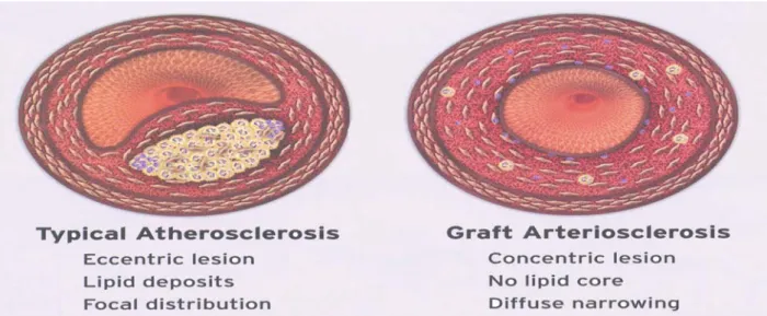 Figura  2 . La figura mostra le due diverse componenti istologiche della malattia aterosclerotica:  l’ateromasia , figura di destra, e la sclerosi, figura di sinistra