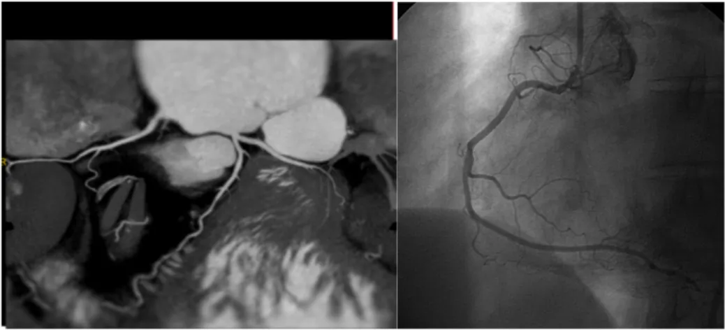 Fig 5. Post – stenting Volume Rendering and MPR: failed overlap of 2 stents. 