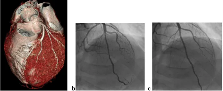Fig  6.  a)  VR  shows  MB  in  II  tract  of  DA;  b)CCA    DA  systolic  squeezing;  c)  CCA  diastolic  phase, 