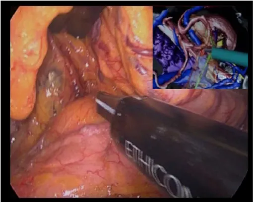 Fig.  3  EndoCAS  Laparoscopic  Navigator  at  work.  The  laparoscopic  surgeon  work  using  the  traditional  real 